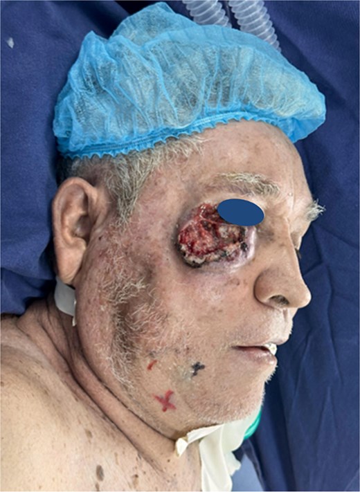 Ulcerated and infiltrative lesion in the right orbitomalar region, with complete destruction of the lower eyelid and extension to adjacent cheek tissues.