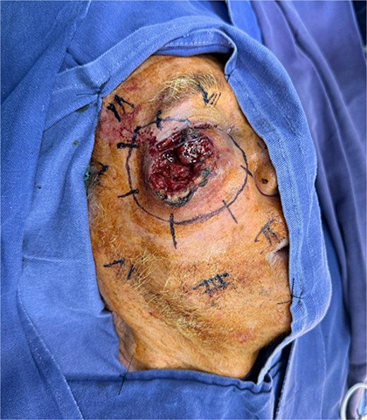 Intraoperative surgical marking showing 1 cm oncologic margins around the lesion.