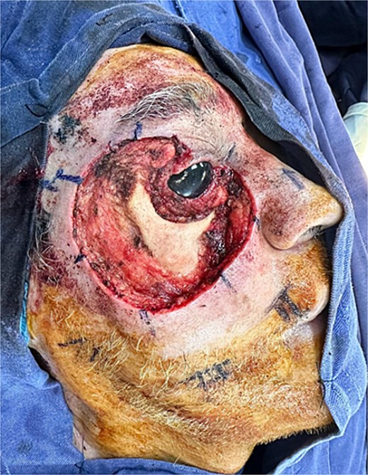 Extensive and complex defect secondary to tumor resection with oncologic margins, involving multiple anatomical subunits including the upper eyelid, lower eyelid, malar, and infraorbital regions.