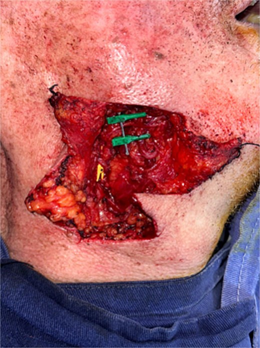Dissection of vessels in the right submandibular region identifying the facial artery and external jugular vein for microvascular anastomosis.