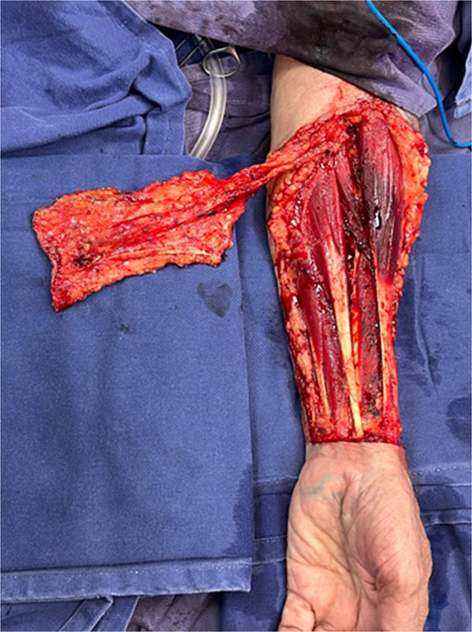Design and elevation of the free radial forearm flap from the left forearm. Inclusion of the palmaris longus tendon and the cephalic venous system is observed.