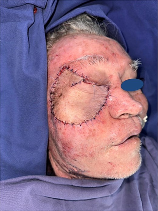 Complete defect coverage following transfer of the radial forearm flap.