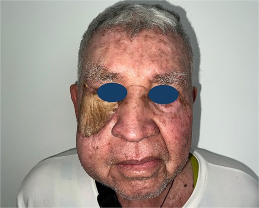 Postoperative follow-up: Satisfactory functional and esthetic outcome, viable flap with no evidence of complications or tumor recurrence.