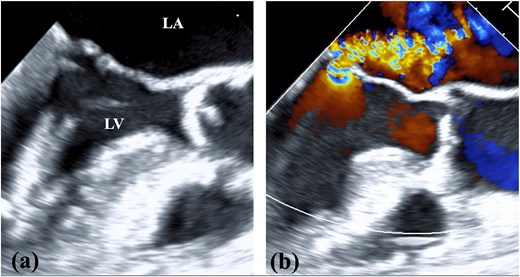 TEE findings. (a) Shortening of the anterior and posterior leaflets of the mitral valve was noted with thickening of the commissure. (b) Both valve leaflets were shortened and the coaptation zone was stiff, resulting in severe MR. LA, left atrium; LV, left ventricle.