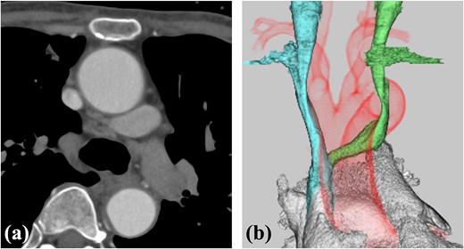 Contrast-enhanced CT. (a) The ALBCV coursed posterior to the ascending aorta. (b) The ALBCV joined the SVC at a peripheral location ⁓3 cm from the right atrium. No right aortic arch or double aortic arch was observed.