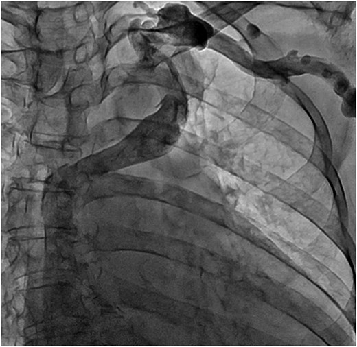 Venography of the left upper limb. The ALBCV joined the SVC, and no communication was observed between the ALBCV and coronary sinus.