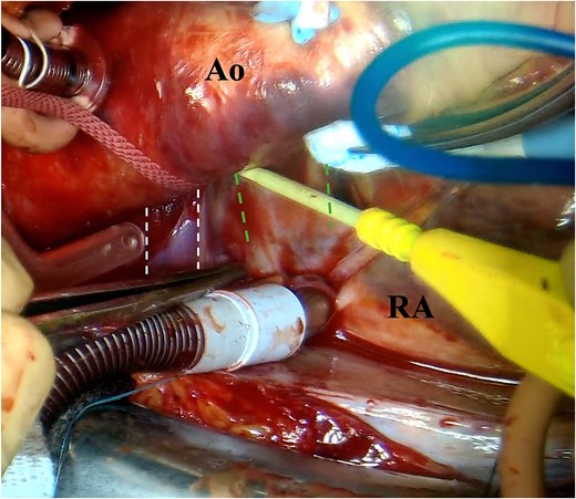 Photograph of the surgeon’s view. The left double-dotted line indicates ALBCV. The right double-dotted line indicates the right pulmonary artery. Ao, aorta; RA, right atrium.