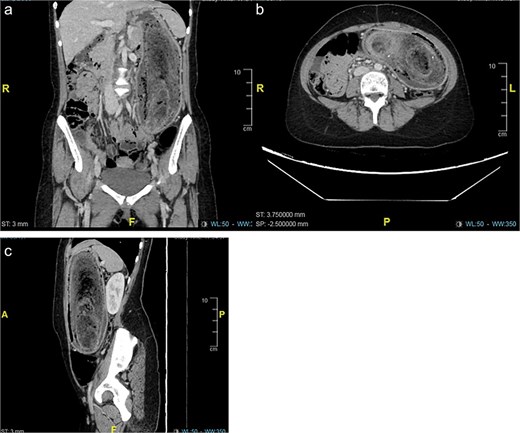 (a–c) Computed tomography (CT) revealed a distended stomach with large endoluminal mass of heterogeneous material likely representing trichobezoar. Mucosal hyper-enhancement of the stomach.
