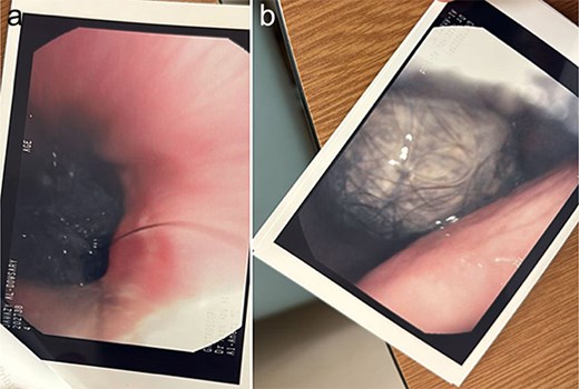 (a and b) Upper gastroscopy revealed a trichobezoar at the lower of gastroesophageal junction and within the stomach.