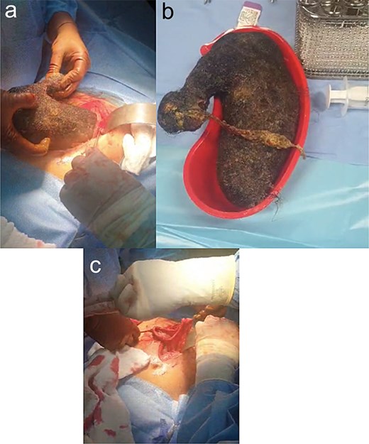 (a–c) Revealed gastrostomy on the anterior stomach wall. A large hair bezoar extending from the stomach into the pylorus was carefully extracted intact.