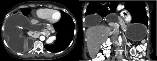 CT scan—the gastric pouch, gastrojejunal anastomosis, remnant stomach, and a portion of the pancreas were located within the thoracic cavity above the diaphragm.