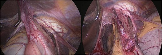 Intraoperative view—large hiatal defect before and after reduction herniated viscera.