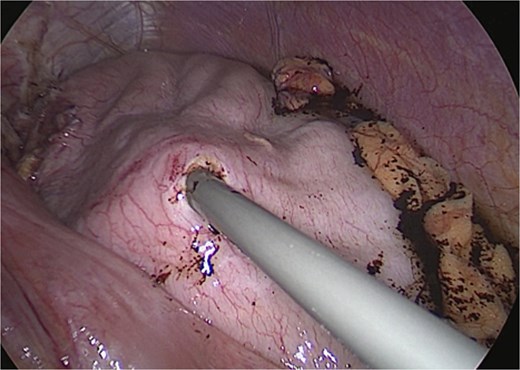 Intraoperative view—gastrotomy and suction of remnant content.