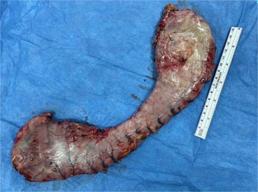 Resected gastric remnant.