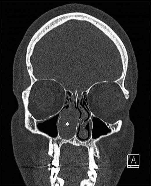 Initial scan demonstrating a mass. Coronal CT scan displaying expansile lesion in the right nasal passage denoted by asterisk. Lesion was noted to have erosion of distal nasolacrimal duct and inferior turbinate without bony erosion. Location of lesion in left nasal passage denoted by dotted circle.