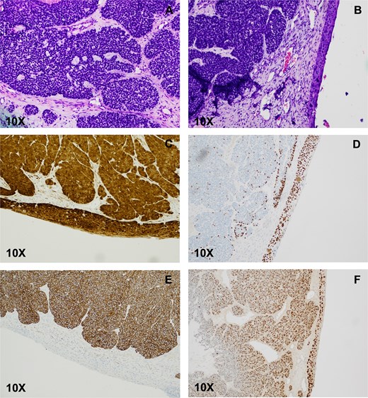 HPV-associated multiphenotypic sinonasal carcinoma. (A) Histologic examination of the right nasal cavity lesion showed a biphasic cell population composed of cells with scant cytoplasm and hyperchromatic nuclei surrounding ductal-type cells arranged in varying sizes of encapsulated solid nests with occasional microcribiform architecture. The ciliated surface epithelium showed replacement with SCC in situ (B), which stained positive for p16 (C), and p40 (D). CK-7 highlighted the basaloid nests (E). Transcriptionally active HPV was confirmed by E6/E7 positivity (F).