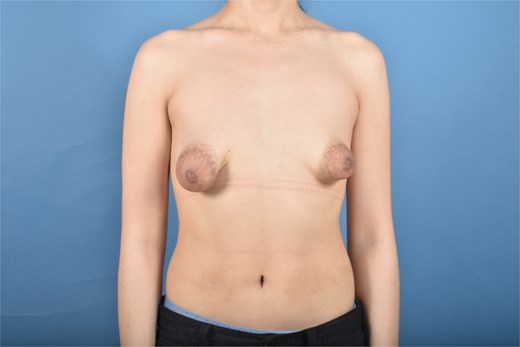 Preoperative anterior view.