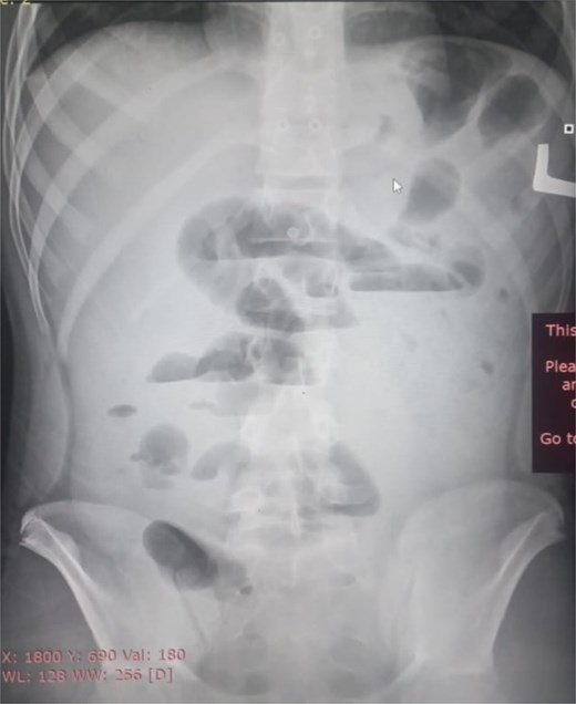 Initial radiographic evidence of bowel obstruction. This preoperative abdominal X-ray shows numerous air-fluid levels and significant distention of the bowel loops, confirming the clinical suspicion of intestinal obstruction.