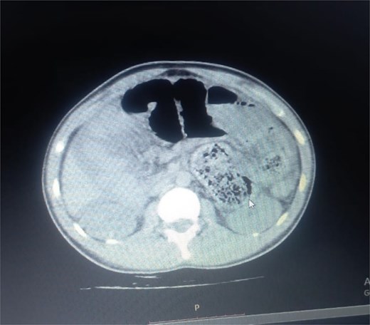 Axial CT demonstrating key pathological features. This contrast-enhanced axial view shows the colon displaced to the left side of the abdomen, confirming the presence of gut malrotation. The centrally clustered small bowel loops are seen encased in a dense sac, forming the characteristic cocoon structure that is pathognomonic for abdominal cocoon syndrome.