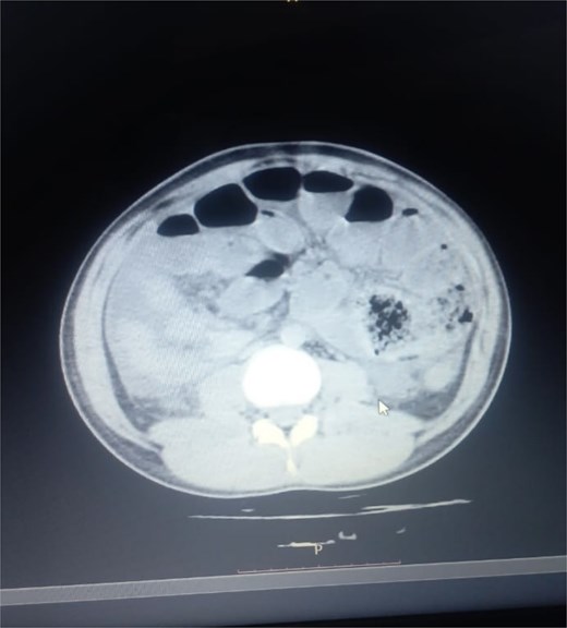 Abnormal positioning of encapsulated small bowel. This axial CT view, taken at a lower abdominal level, illustrates the profound anatomical derangement. The entire cluster of small bowel loops is seen encased and displaced into the right iliac fossa, a finding consistent with the combined effects of the cocoon membrane and the patient’s gut malrotation.