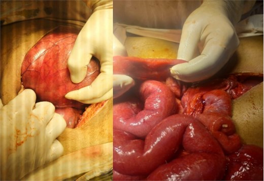 Intraoperative findings of idiopathic Sclerosing encapsulating peritonitis. The image displays the abdominal viscera entirely encased within a smooth, thick, cocoon-like sac, consistent with abdominal cocoon syndrome. The whitish, glistening appearance of the membrane is characteristic of its dense, fibrocollagenous composition, which was later confirmed by histopathology.