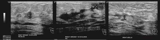 (Left, middle) Ultrasound images of the right breast irregular spiculated hypoechoic mass with ill-defined margins, associated with a dilated duct 3 mm; (Right) Ultrasound image of the enlarged axillary lymph node.
