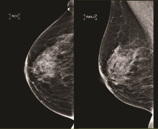 (Left) Mammography cranial-caudal view of right breast; (Right) Mammography mediolateral oblique view of the right breast: Both showing few loose clusters of faint and punctate microcalcifications in the upper outer right breast with no suspicious linear or tight cluster of microcalcifications.