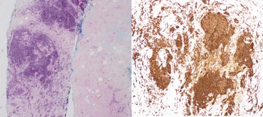 (Left) Breast core biopsy showing periductal atypical lymphoid proliferation. (H&E stain, 20 times magnification); (Right) Breast core biopsy with immunohistochemical staining showing atypical lymphoid cells positive for CD20 stains.