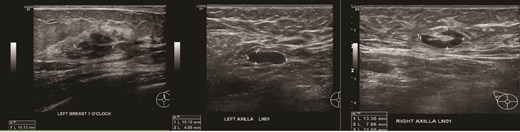(Left) Ultrasound images of the left breast ill-defined hypoechoic mass; (Middle, Right) Ultrasound images of the axillary lymph nodes with cortical thickening and effacement of the fatty hilum.