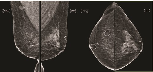 (Left) Mammography medioloateral oblique views of bilateral breasts; (Right) Mammography cranial-caudal views of bilateral breasts: Left upper central breast shows a vague focal asymmetry corresponding to the palpable concern, and several prominent right axillary lymph nodes.
