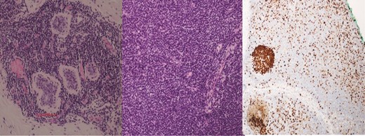 (Left) Breast core biopsy showing neoplastic lymphoproliferation around benign duct (H&E stain, 20 times magnification); (Middle) Breast core biopsy with immunohistochemical staining showing atypical lymphoid cells positive for CD20 stains; (Right) lymph node core biopsy showing distorted architecture by an infiltrate of small lymphocytes involving entire node (H&E stain, 20 times magnification).