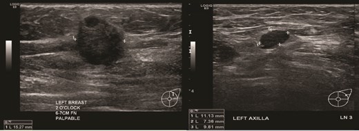 (Left) Ultrasound image of the left breast hypoechoic lesion; (Right) Ultrasound image of one of several enlarged lymph nodes with effacement of fatty hilum.