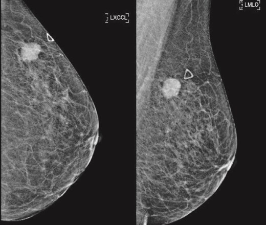 (Left) Mammography cranial-caudal view of left breast; (Right) Mammography mediolateral oblique view of the left breast: Left upper outer breast spiculated mass with minimal architectural distortion.