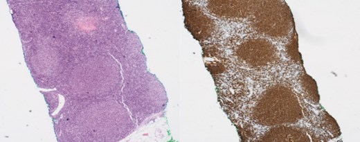 (Left) Breast core biopsy showing follicular hyperplastic nodules of atypical lymphoid cells (H&E stain, 40 times magnification); (Right) Breast core biopsy with immunohistochemical staining; atypical lymphoid cells forming hyperplastic nodules positive for CD20 stains.