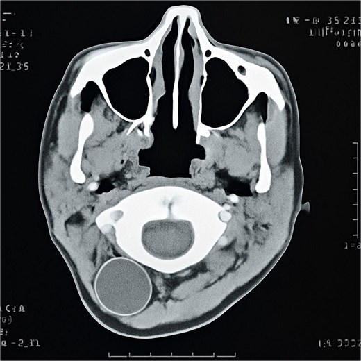 CT scan of the head and neck showing the cervical cystic mass.