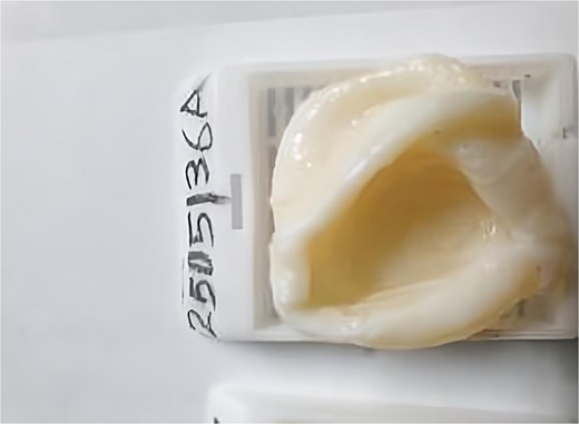 Postoperative view of the cyst.