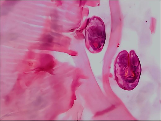 Histopathological image shows daughter cysts in the hydatid cyst.