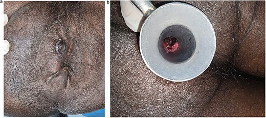 (a) Clinical image showing multiple perianal satellite nodules ⁓6 cm in total distribution. (b) Proctoscopic image showing blackish discoloration of anal mucosa with pigmented tumor within anal canal.