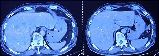 CECT abdomen and pelvis showing hepatic metastasis and pulmonary metastasis.