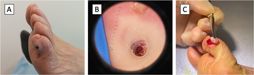 Schwannoma, the clinical presentation. (A) The patient presented with an ulcerated palpable round mass measuring 6 mm located on the lateral aspect of the fifth left toe. (B) Dermoscopy of the schwannoma showed a 3 mm ulceration with no pigmentation or vascular structures. (C) Excision of the tumor revealed an encapsulated, well-circumscribed schwannoma.