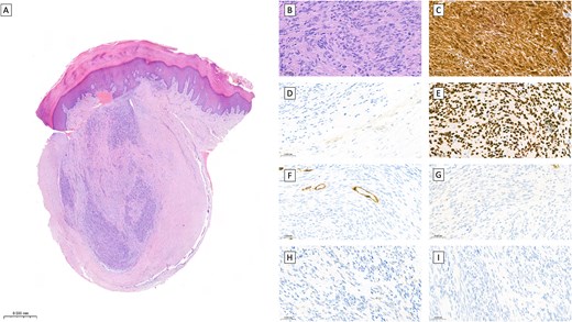 Schwannoma, the histological findings. Hematoxylin and eosin staining (A, B) and immunohistochemical staining (C–I) of the excised schwannoma. Overview of the excised schwannoma, bar = 0.5 mm (A). Histological image from the schwannoma with Antoni A pattern. The spindle-shaped cells show discreetly palisading arrangement around fibrillary processes (Verocay bodies) (B). The perineural capsule with positive immunoreactivity in EMA (D). The spindle cells are positive for S100 (C) and SOX10 (E) and negative for CD34 (F), CKAE (G), Melan-A (H) and NF (I). Magnification: (B–I) ×400.