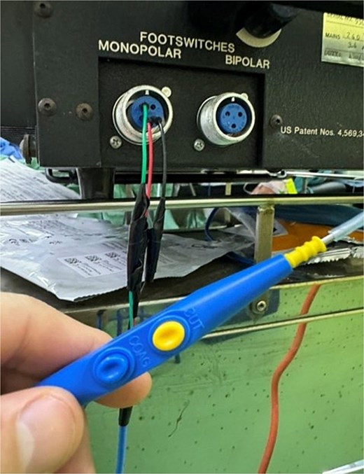 Pencil diathermy cables inserted into respective pins of monopolar footswitch socket of ESU.