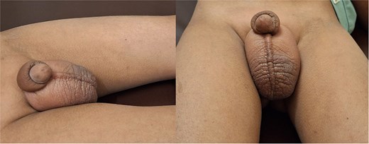 Erythematous penoscrotal swelling in the patient.