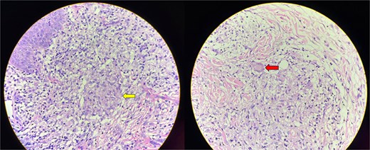 Skin biopsy showing an inflammatory infiltrate with lymphocytes, plasma cells and macrophages. Ill-defined, non-caseating granulomas with epithelioid cells are present (arrow in the first image). Langhans-type of multinucleated giant cells are seen (arrow in the second image).