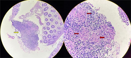 Colon biopsy showing mucosal ulceration and mixed inflammatory infiltrate (arrow in the first image). Poorly-defined epithelioid granulomas (arrows in the second image) with no evidence of necrosis seen.