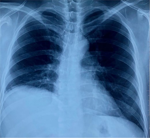 The chest X-ray demonstrated an elevated right hemidiaphragm.