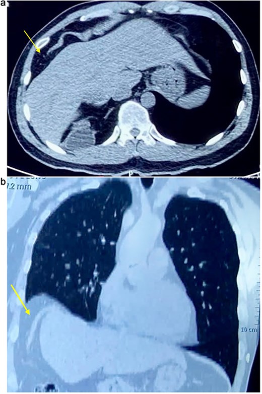 (a) Axial CT scan showing an arrow pointing to a discontinuity of the right diaphragm muscle near the right chest wall. (b) Transverse CT scan showing an arrow pointing to a communication between the peritoneal fat of the abdominal cavity and the right pleural space at the lung base.