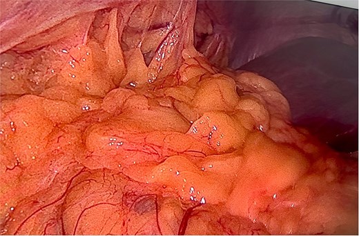 Intraoperative image reveals a right hemidiaphragm defect with omental protrusion and hepatic colon adhesion.