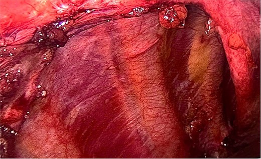 After releasing, the herniated components and reducing them back into the abdominal cavity.