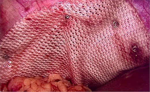 Intraoperative image demonstrating composite mesh placement over the diaphragmatic defect.